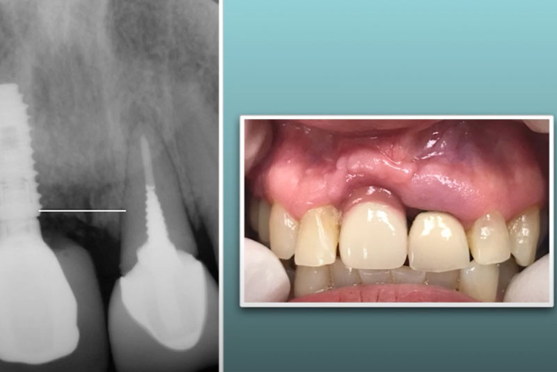 Ultratooth vs Traditional Implant