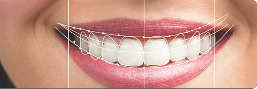 Smile Preview & Digital Smile Design